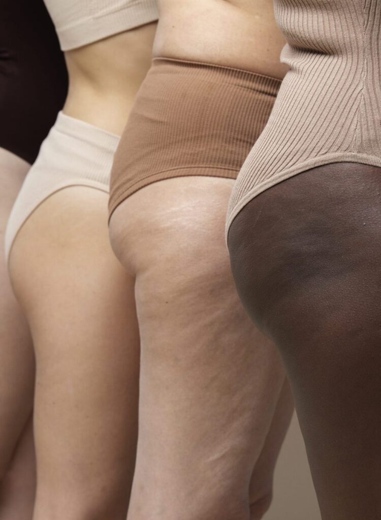 Körperbereich mit Fettdepots als Symbolbild für eine Injektionslipolyse Behandlung